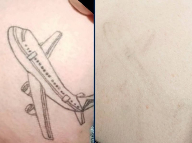 Resultat detatouage avant/apres